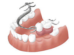 部分入れ歯