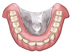 金属床入れ歯（自費診療の入れ歯）