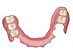 ノンクラスプデンチャー（自費診療の入れ歯）