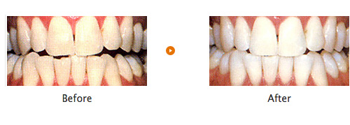 歯を白くするホワイトニング