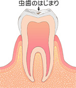 初期齲蝕（C0）