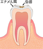 エナメル質齲蝕（C1）