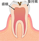 象牙質齲蝕（C2）