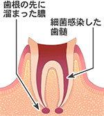 根の治療