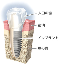 インプラント